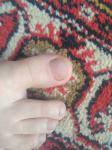 Проблемы с ногтем фото 2