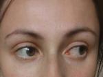Воспаление глаза - последствие конъюнктивита фото 1