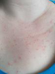 Что это за сыпь, аллергия? фото 1