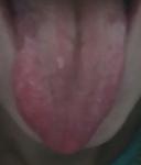 Припухлость языка и щеки фото 1