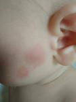 Герпетическая инфекция у ребёнка 9мес фото 1