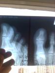 Перелом ногтевой фаланги большого пальца правой ноги фото 1