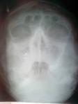 Гайморит или что-то другое(рентген) фото 1
