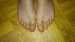 Непонятные пятна на пальцах ног фото 1