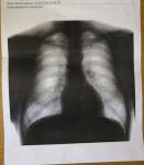Корни лёгких фиброзно изменены фото 1