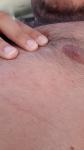 Сыпь в области груди и шеи фото 1