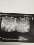 Иммуноглобулин антирезус при замершей беременности фото 1