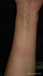 Красные пятна на руке, лечение на ГВ фото 1