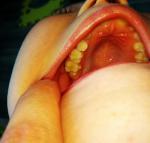 6 зуб у ребенка фото 3