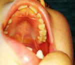 6 зуб у ребенка фото 2