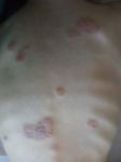 Стойкая сыпь, атопический дерматит, дальнейшая тактика лечения фото 1