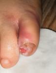 Воспаление пальца на ноге у ребенка фото 2
