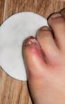 Воспаление пальца на ноге у ребенка фото 1