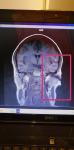 Изменения на МРТ в области ЛОР органов фото 2