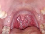 Боль в горле, подозрение на золотистый стафилококк фото 2