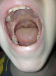 Пузырьки в горле у ребенка фото 2