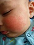 Аллергия или диатез фото 1