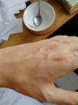 Красные зудящие пятна на руке похожие на укусы фото 1