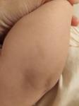 Белый ореол вокруг родимого пятна у ребенка фото 1