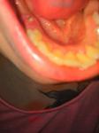 Разрушен зуб заростает, не болит фото 3