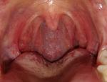Красное горло, увеличены миндалины, волдырьки фото 1