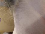 Сыпь на шее, груди и область сгиба локтей фото 3