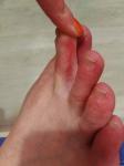 Красная сыпь на пальцах ног фото 2