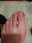 Красная сыпь на пальцах ног фото 3