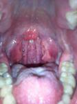 Зарубцована мендалина, жжение в горле и ухе фото 5