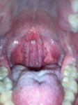 Зарубцована мендалина, жжение в горле и ухе фото 4