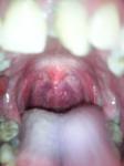 Зарубцована мендалина, жжение в горле и ухе фото 2