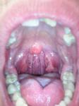 Зарубцована мендалина, жжение в горле и ухе фото 1