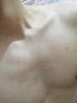 Красные пятна, в области груди шеи живота, небольшой зуд фото 2