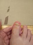 Это грибок ногтя или повреждение после удаления фото 2