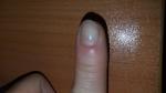 Инфекция ногтей фото 1