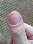 Трещина на ногте большого пальца руки фото 1