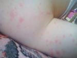 Аллергия это или инфекция? фото 1