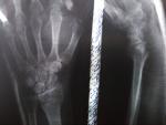 Жжение и боль после перелома кисти руки фото 3