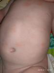Аллергия или дерматит? Ребёнок 4 месяца фото 3