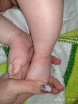 Аллергия или дерматит? Ребёнок 4 месяца фото 1