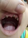 Зуб в десне фото 1