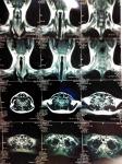 Расшифровать МРТ мягких тканей шеи фото 3