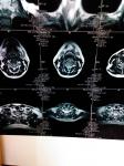 Расшифровать МРТ мягких тканей шеи фото 2