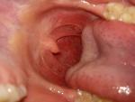Ком в горле, увеличение лимфоузлов в левой стороне, отдышка фото 1