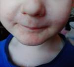 Сыпь на лице ребенка фото 1