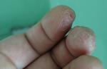 Трещины верхних фаланг пальцев, шелушение кожи фото 3
