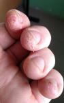 Трещины верхних фаланг пальцев, шелушение кожи фото 4