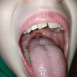 Красные пятна у ребенка во рту фото 1
