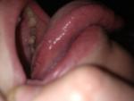 Воспаление языка фото 2