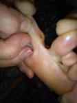 Болезненный нарост на пальце ноги фото 5